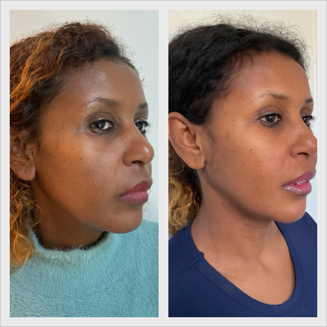 Before and after skin treatment, side profile of a Derma Radiance patient